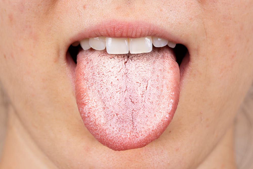 چگونه برفک دهان رو از بین ببریم؟